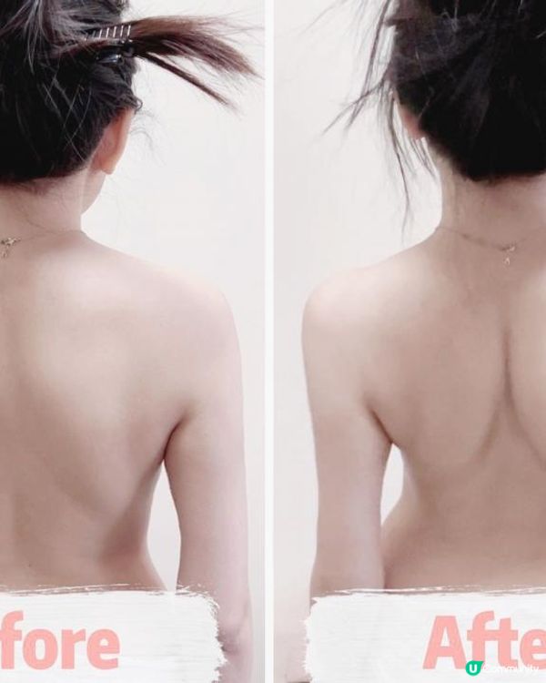 Dr. Yan健康骨骼及專業護脊中心 收費脊椎側彎治療的效果 Dr Yan好唔好 (吳錞銦)