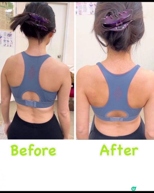 Dr Yan 健康骨骼好唔好 (吳錞銦), 收費vs效果, 脊椎側彎治療過程