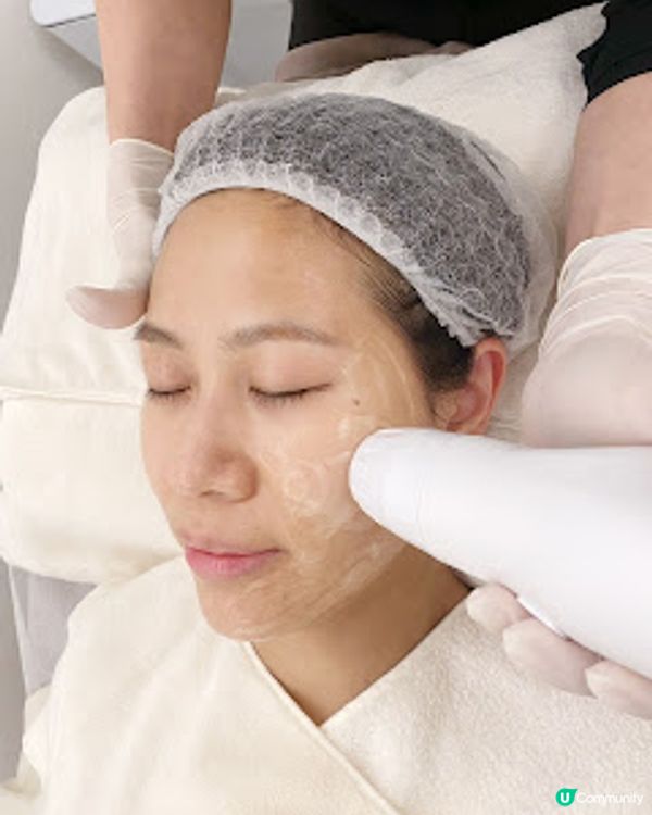 ★想逆齡生長+立體V面 我揀左FIDES既Hifu無針埋線療程! 即睇效果!★