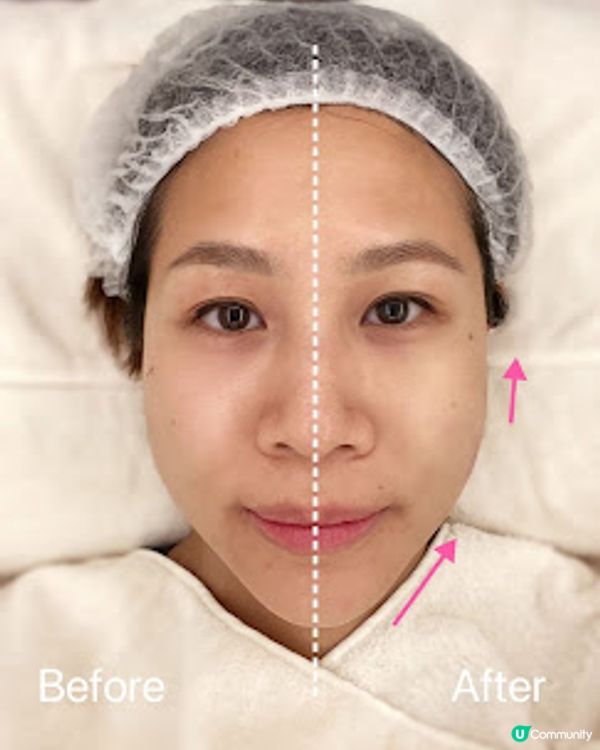 ★想逆齡生長+立體V面 我揀左FIDES既Hifu無針埋線療程! 即睇效果!★