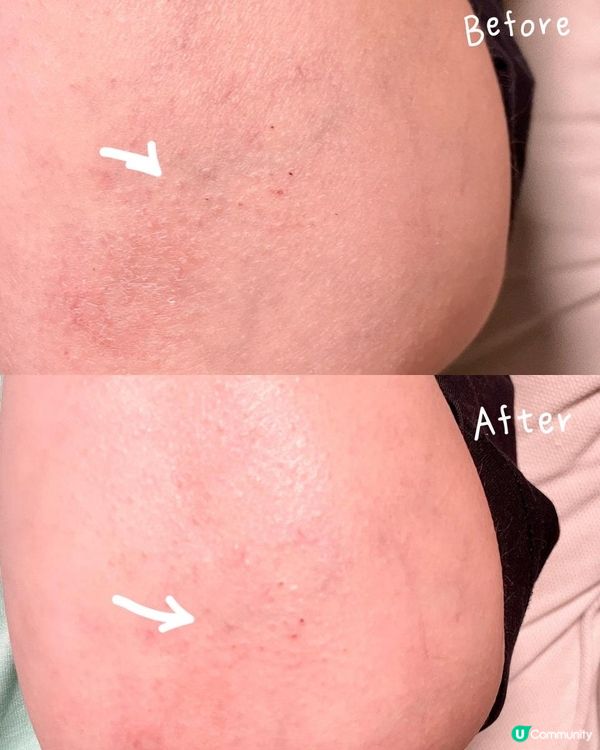 #舒緩濕疹有妙法 #樂道漢藥花煥膚舒 #濕疹唔再痕唔再癢