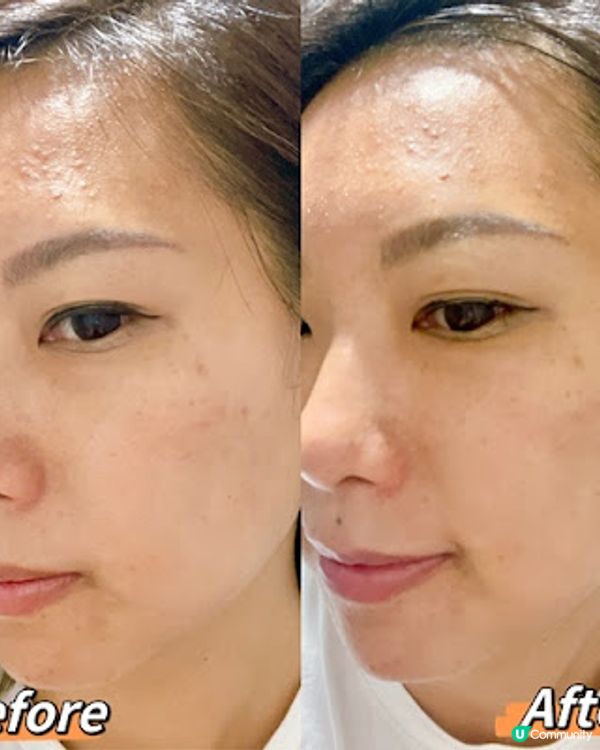 養康中醫館新出中藥藥膜超驚喜，原來暗瘡都可以敷中藥mask！