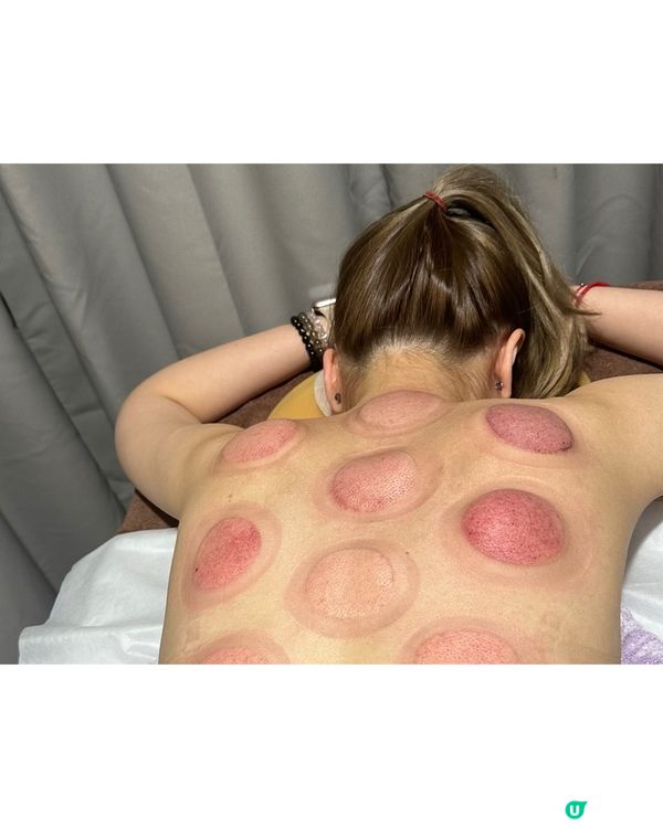 養生體驗🌟 養康中醫館人氣拔火罐袪濕氣療程