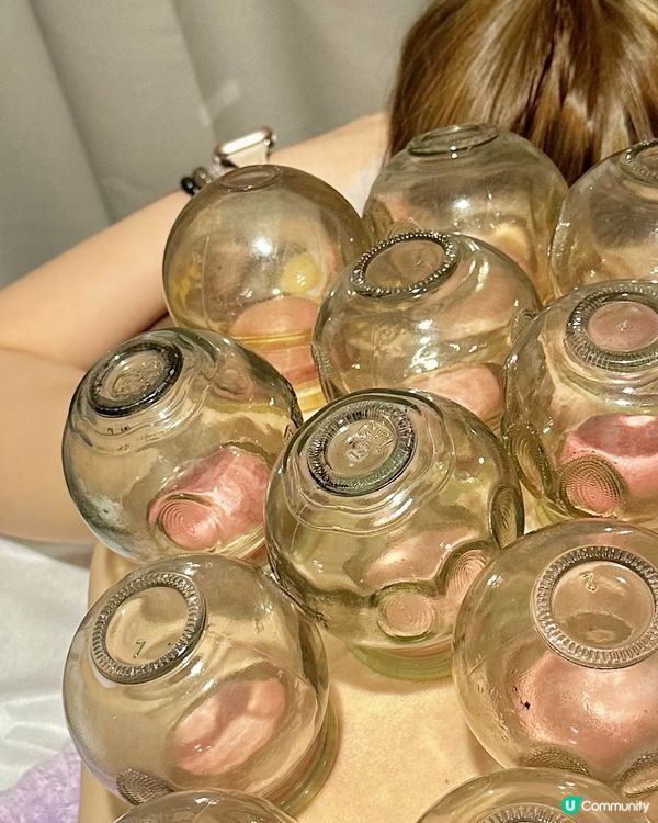 養生體驗🌟 養康中醫館人氣拔火罐袪濕氣療程