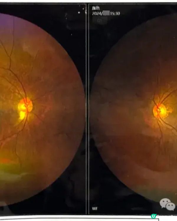 陪我妈妈去医院看眼科日记
