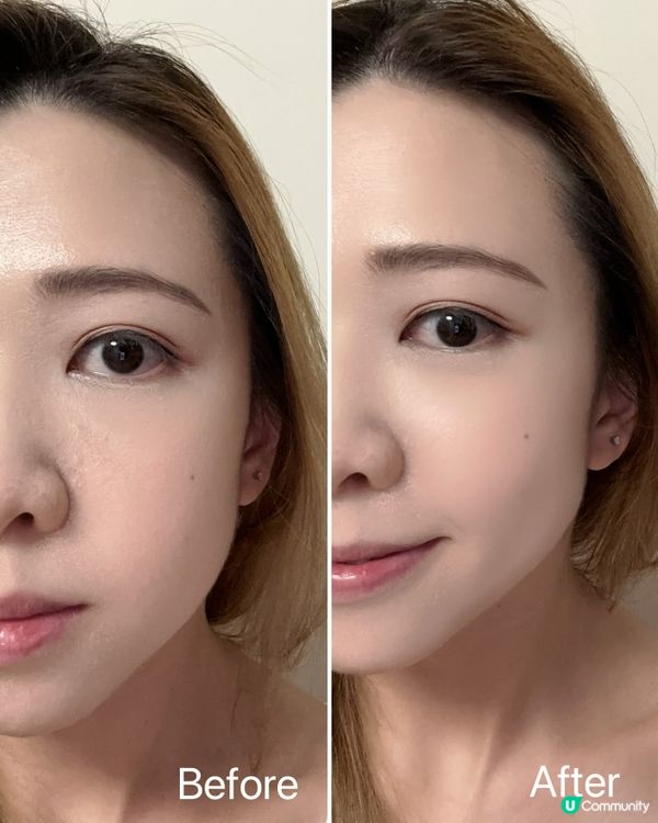 醫學煥膚去色斑✨