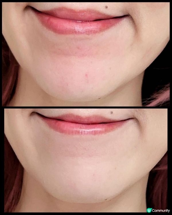 面部敏感泛紅神器 EMAY PLUS 殺痘小飛船5分鐘即時降紅！