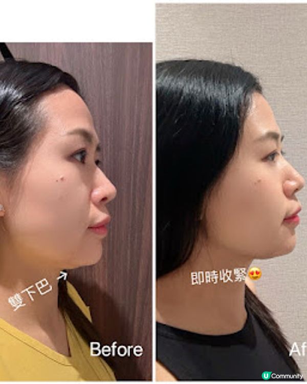 ★收緊下巴輪廓, 無晒雙下巴! Nume名人美學★