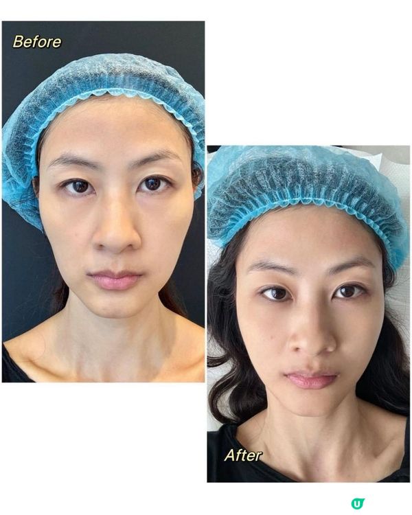 銅鑼灣 NuMe 名人美學 - 擊退夏日斑斑,皮秒激光去斑護膚