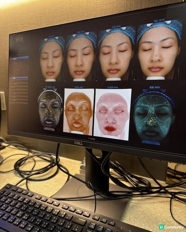 銅鑼灣 NuMe 名人美學 - 擊退夏日斑斑,皮秒激光去斑護膚