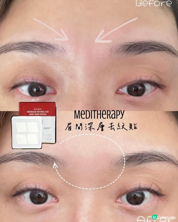 眉間紋﹑法令紋救星，我貼等如使用10次精華素