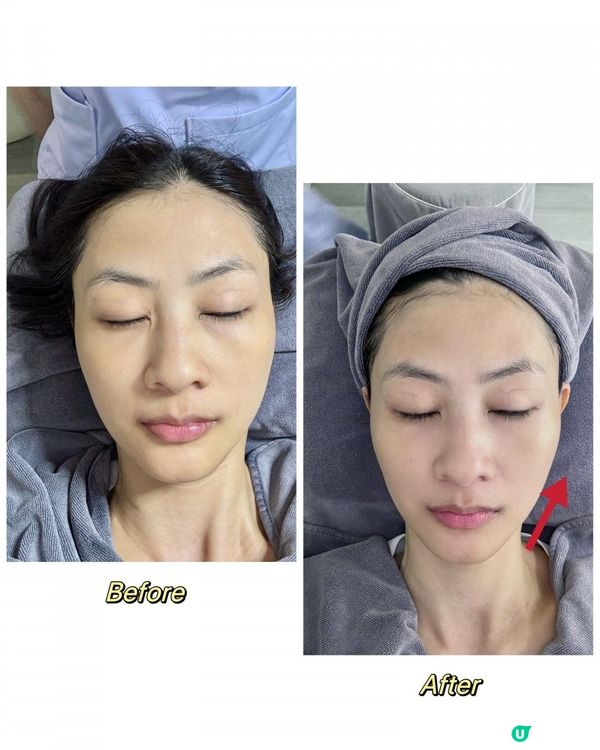 膠原蛋白BoomBoom~ 必做Sky Beauty Fitness膠原槍!