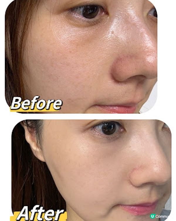 夏天瘋狂出斑？！超有效去斑：enLIGHTen 皮秒激光去斑 $333,$999/3次