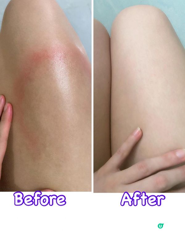 勁work無類固醇濕疹外用煥膚舒