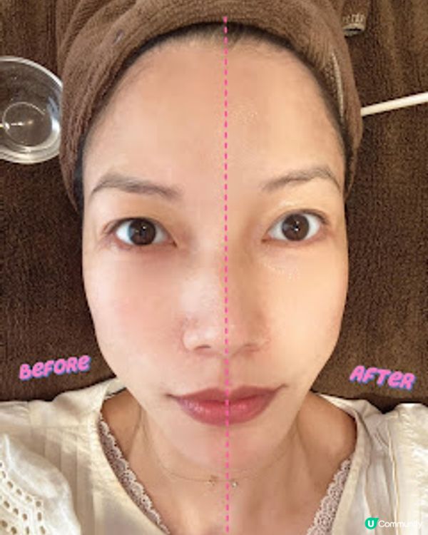 Queen’s Beauty & Spa 逆時針療程 無需針劑注射 強效抗衰老 面部輪廓即時提升