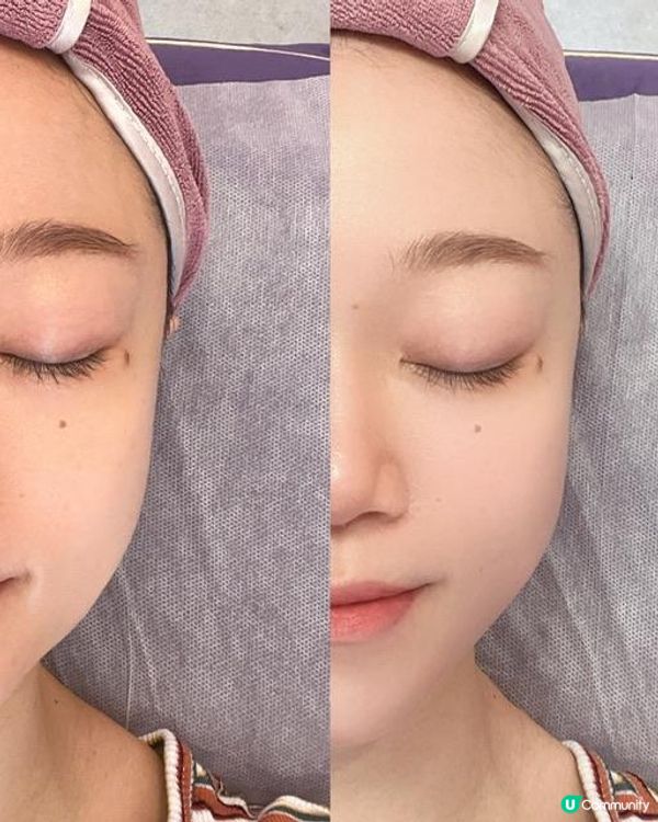 perfectslimhk 日式小顏術 徒手小顏矯正