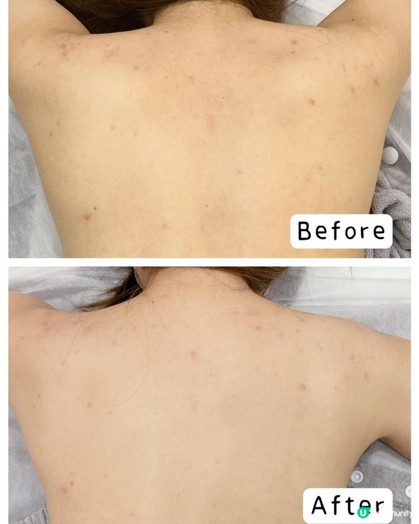 想自信露出美背，就要幫背部肌膚做去印護理🌟