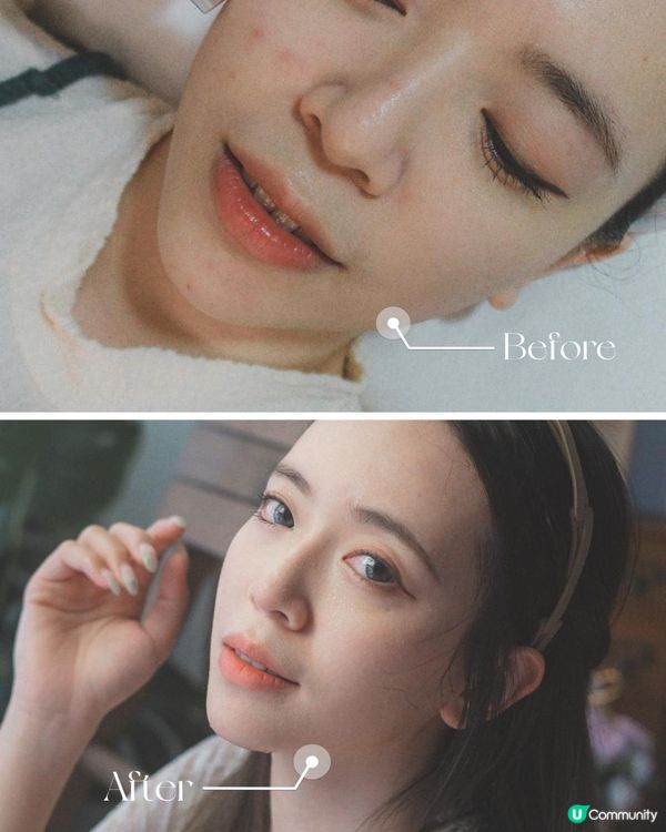 公開血淚抗痘之路！喺Alyssa搵到解決原生痘肌的方法