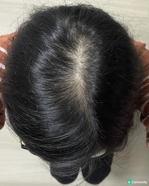 一月專題：改善頭髮稀疏/脫髮困擾