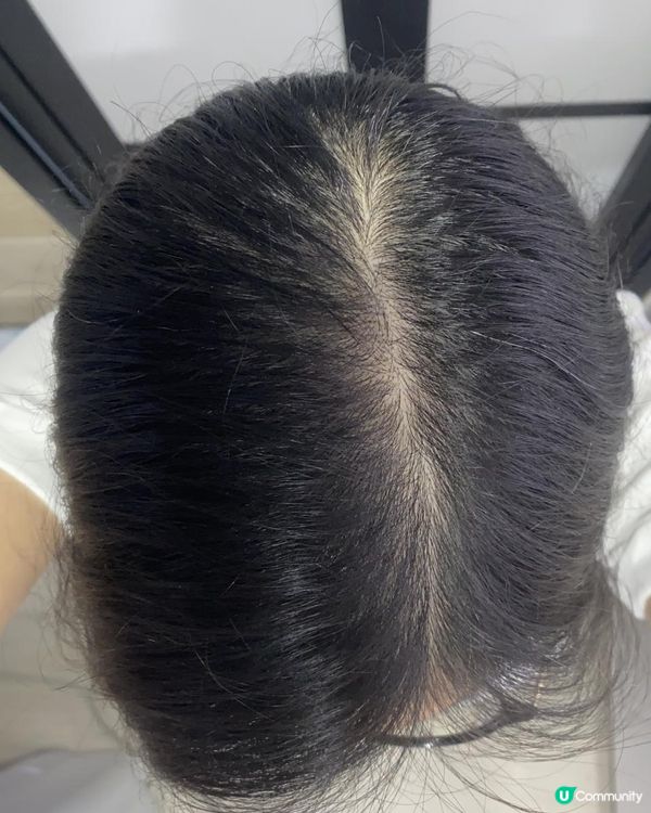 一月專題：改善頭髮稀疏/脫髮困擾