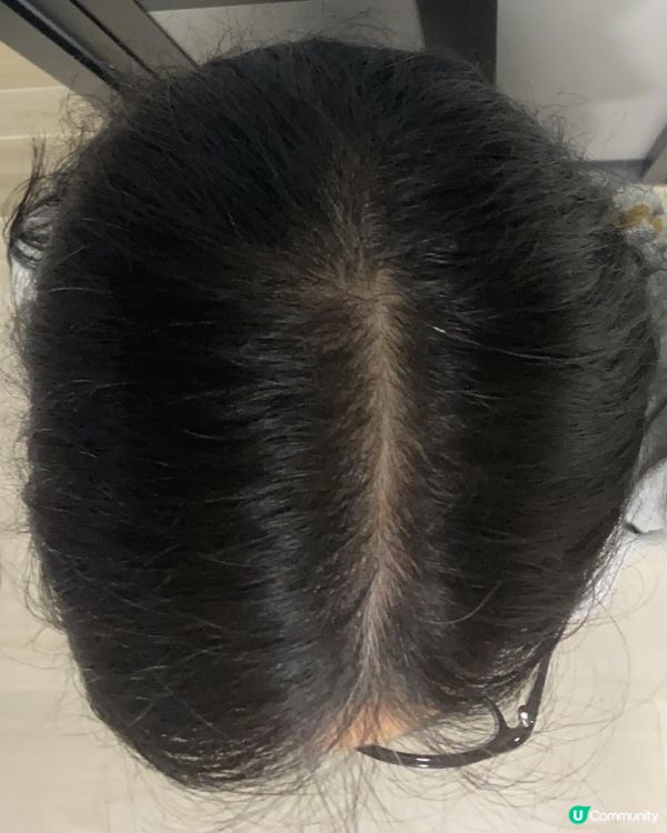 一月專題：改善頭髮稀疏/脫髮困擾