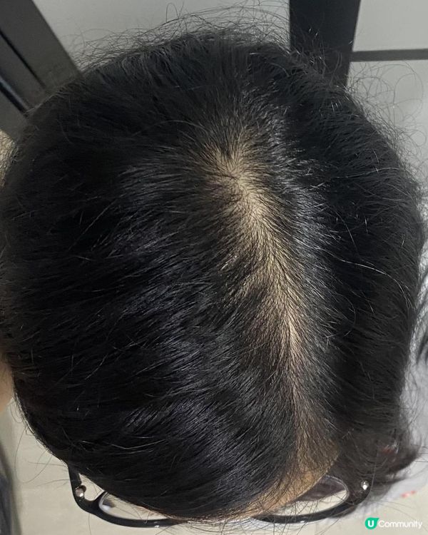 一月專題：改善頭髮稀疏/脫髮困擾