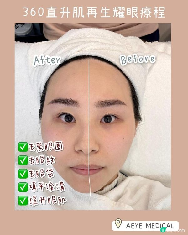 A-EYE MEDICAL ° ꎺ⠜° 去黑眼圈、眼袋無難道