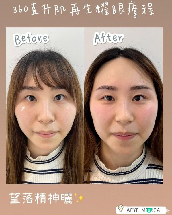A-EYE MEDICAL ° ꎺ⠜° 去黑眼圈、眼袋無難道