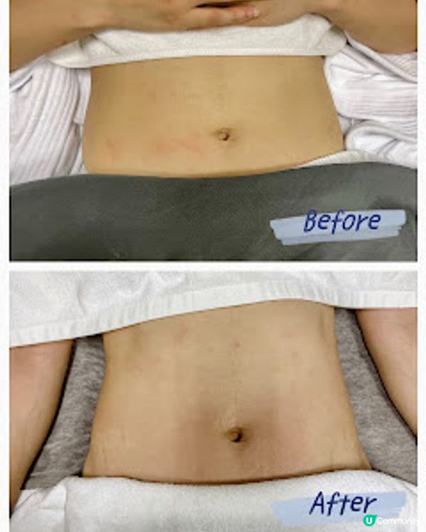 隔空溶脂有無用？實測Dr. Miracle隔空溶脂一次療程效果