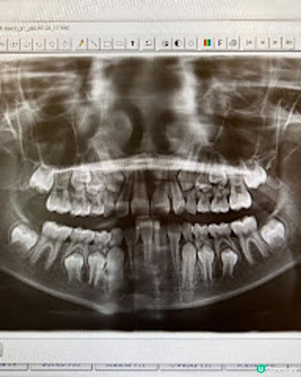 隱適美兒童專線 有助及早預防各類牙齒生長發育問題 