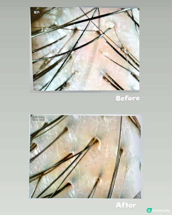 瞓得好啲～養生頭皮SPA + 針炙💆🏻‍♀️