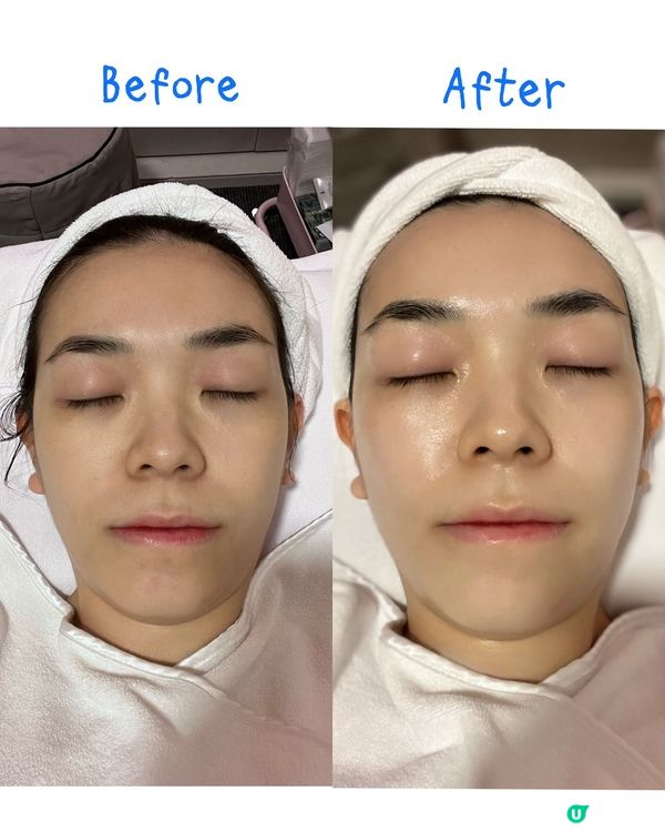 RF 膠原蛋白增生！星辰Glow up療程