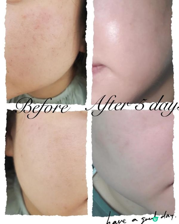 光子嫰膚效果明顯