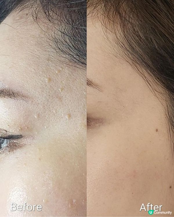 終於的起心肝去脫疣