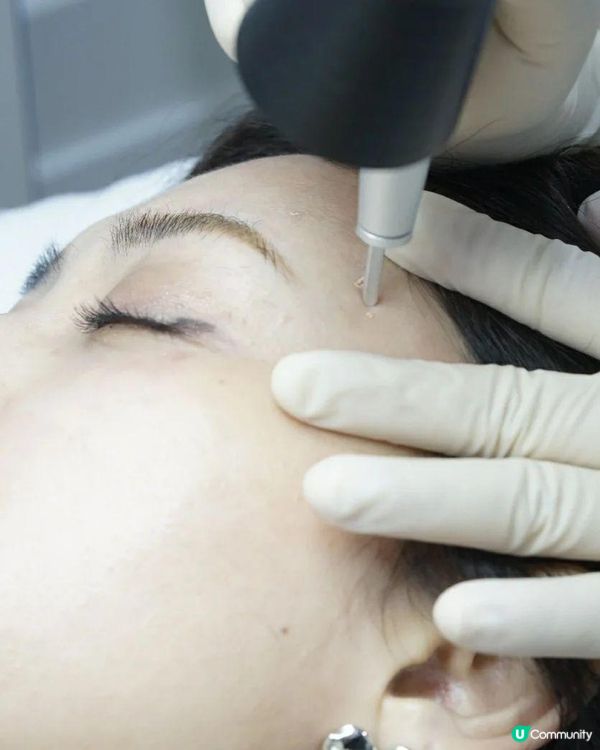 終於的起心肝去脫疣