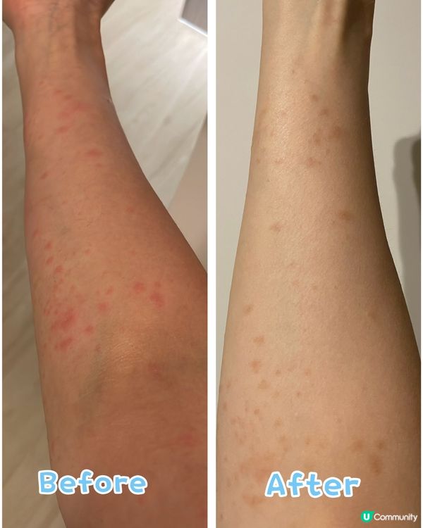 濕疹痕到瞓唔著 😭  @8 濕疹三寶救我命！