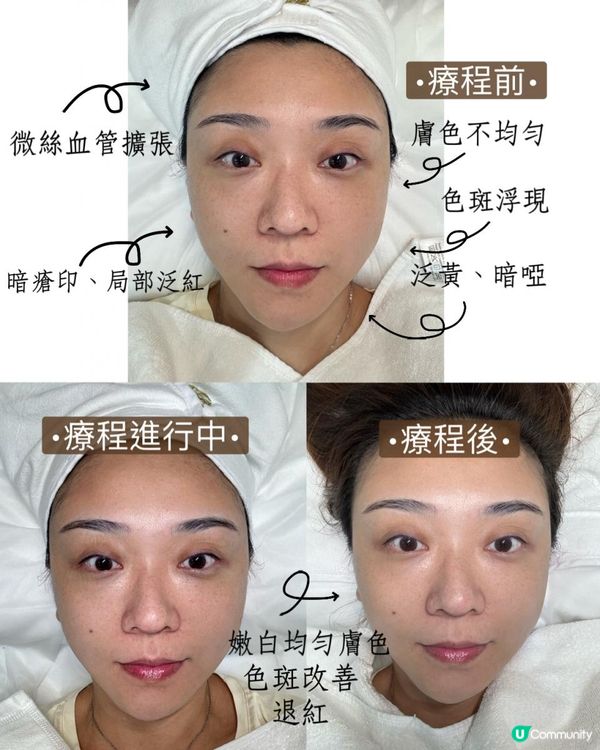 體驗Stellar M22 OPT™強效脈衝光療程