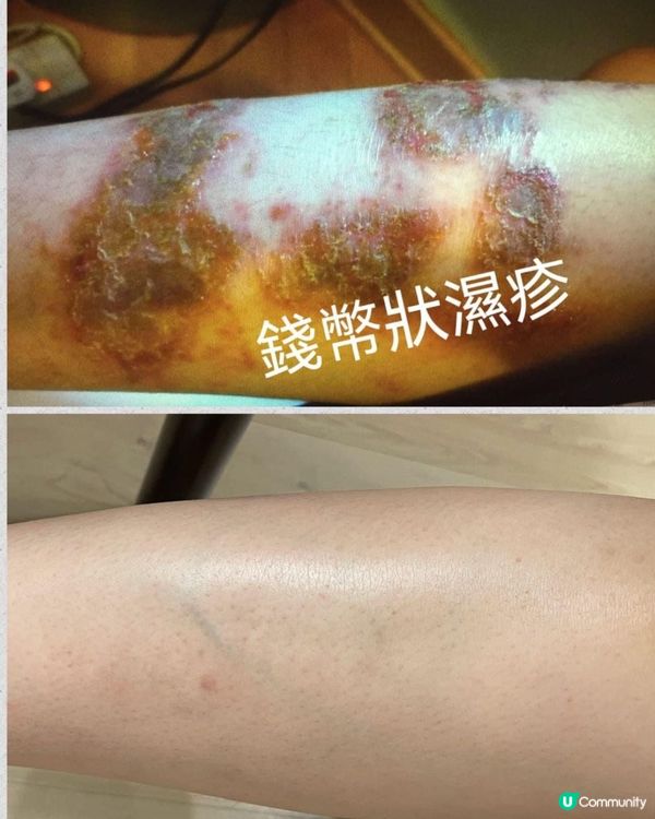 走出濕疹的痛苦幽谷🌈