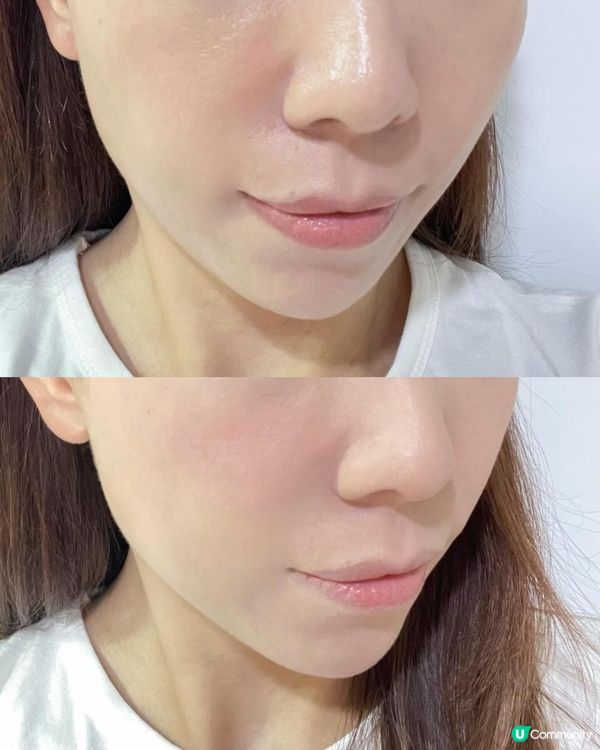 敏感泛紅處理法 | EMAY PLUS 等離子淨顏儀