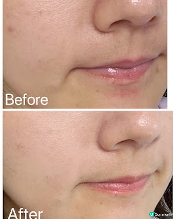 暗瘡救星 - EMAYPLUS殺痘⼩⾶船