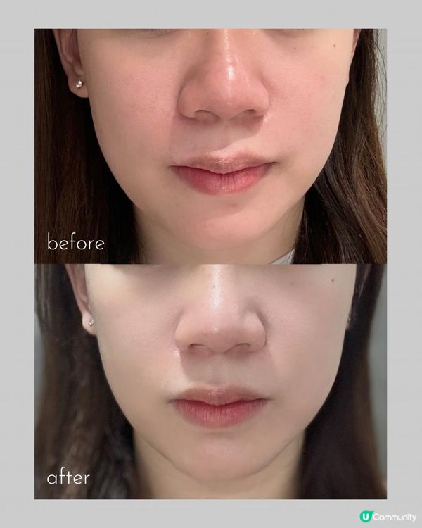 居家養膚美容儀  ZIIP HALO 一機多效✨實測4星期 徹底逆轉膚質😍