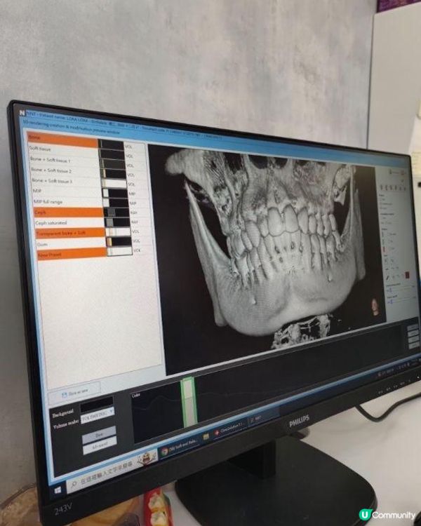 箍牙體驗：選擇齊仁牙科中心透明牙箍的療程