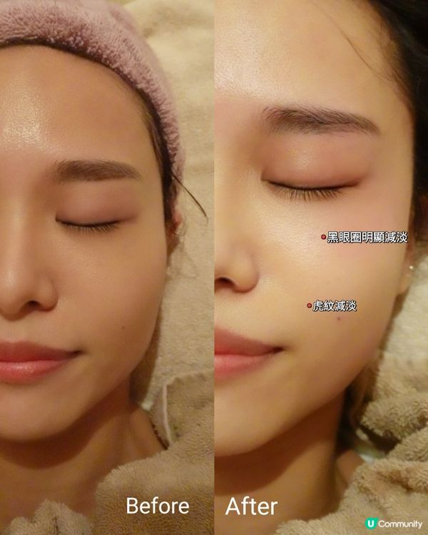 膠原流失？急救！ 💉  360 膠原修復槍，重拾青春！ ✨