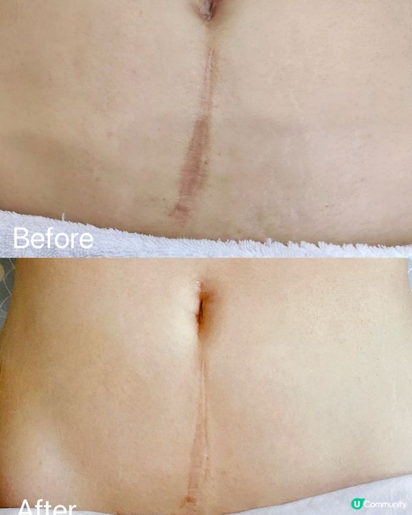 易理妥「🩹加大片裝褪疤貼」