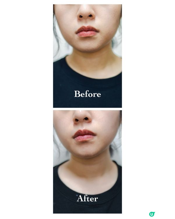 V臉塑顏面膜💕｜助你自信企最前💆🏻‍♀️