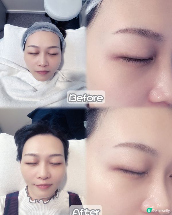 30分鐘即時見效黑眼圈美顏針