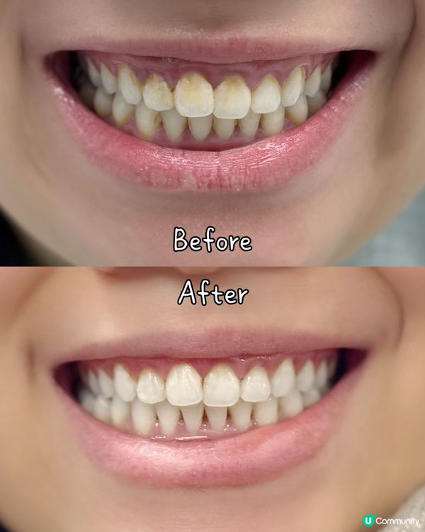 #格倫菲爾靚牙之旅 🦷😁!