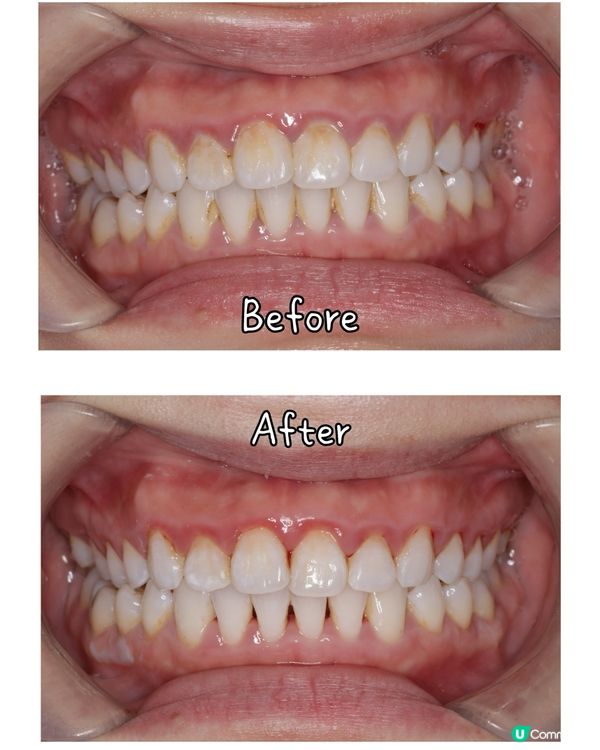 #格倫菲爾靚牙之旅 🦷😁!