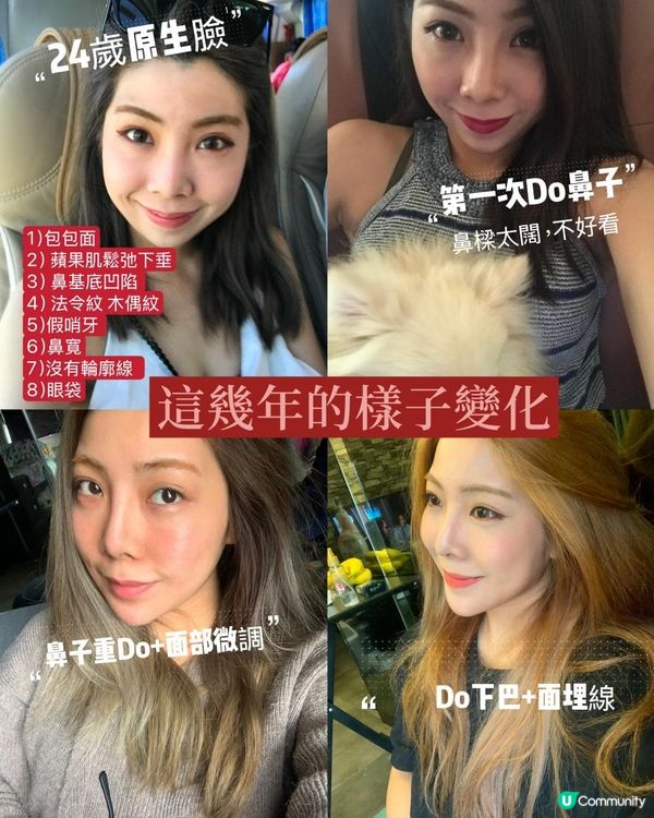 後天變美｜10年醫美成果｜微整形鼻子，不動刀也可以變美