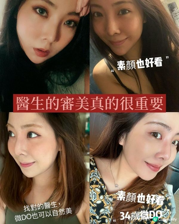 後天變美｜10年醫美成果｜微整形鼻子，不動刀也可以變美
